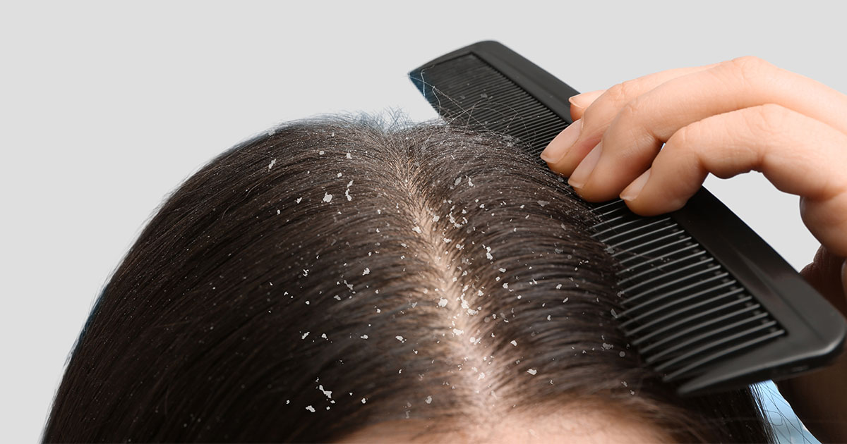 Korpás haj kezelése télen - hatékony megoldások